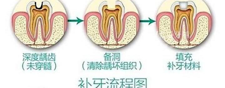 补牙材料价格表（牙齿龋坏后需补牙）