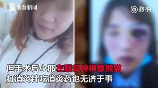 青岛双眼皮价格（青岛小嫚割个双眼皮）