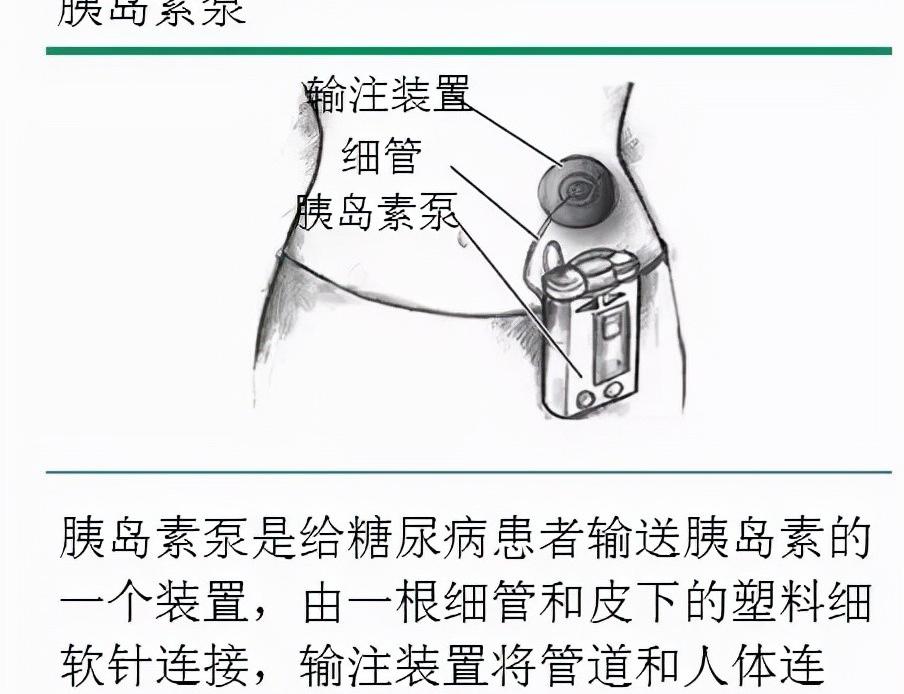 胰岛素泵价格最新价格（胰岛素泵控糖真这么好吗）