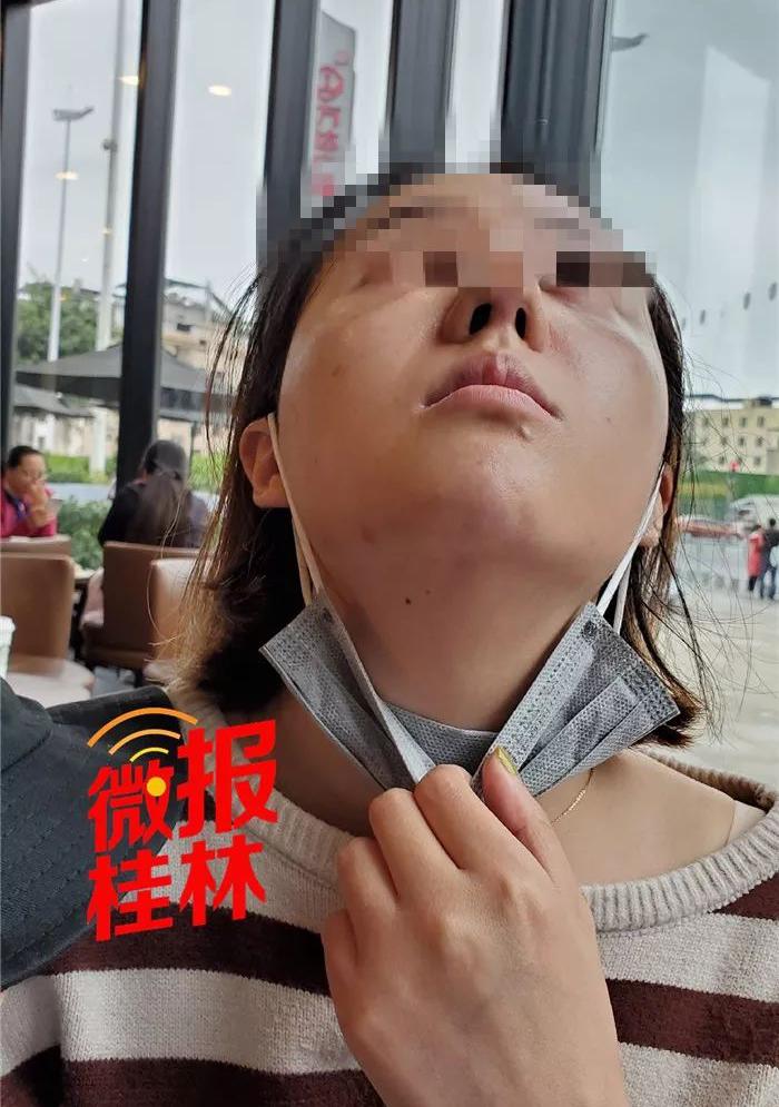 整形鼻子价格（桂林女子花37000元整容）