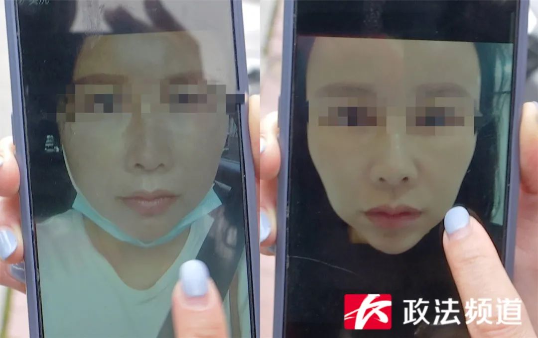 脸整形要多少钱（糟心）