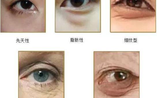 去除眼袋术多少钱（如何去眼袋）