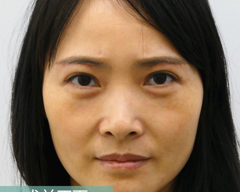 正规医院做眼袋多少钱（做内吸去眼袋失败后）