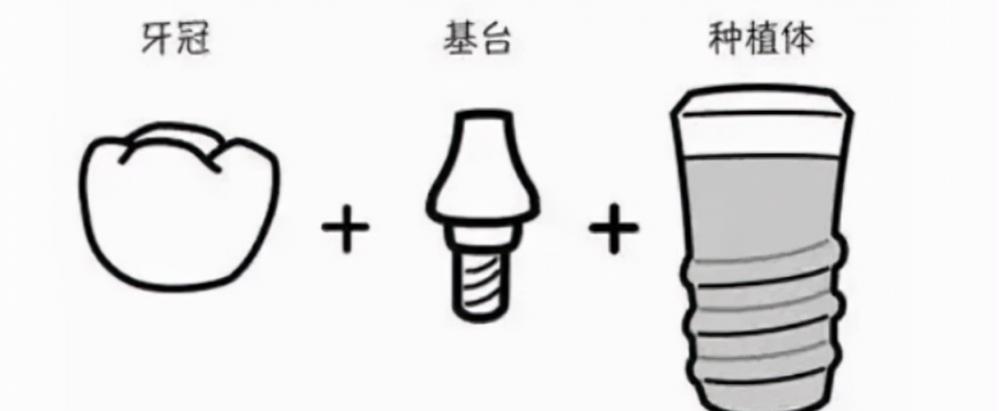 种植牙要多少钱一颗（北京房山一颗种植牙多少钱）