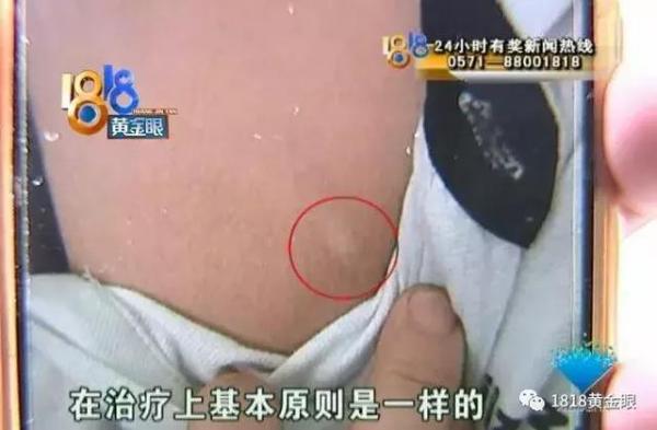 白殿疯确诊要多少钱（两个白点）