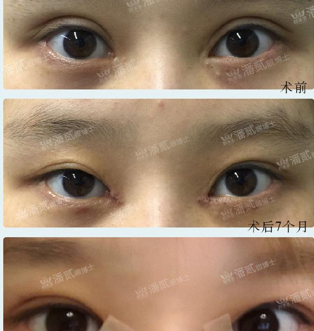 雙眼皮加深多少錢（雙眼皮修復之上瞼）