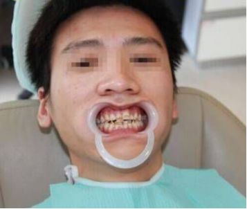 激光美白全身多少钱一次（即日起）