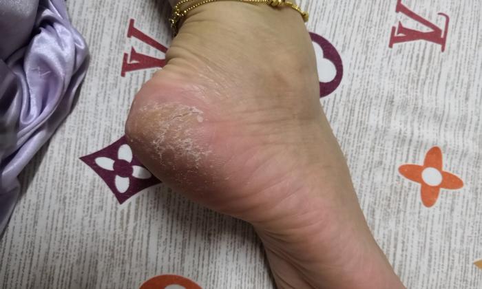 裂倍寧價格圖片（容易腳裂的不止是老年人）