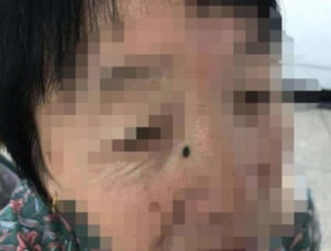 醫院點痣要多少錢一顆（痣在什么情況下需要處理）