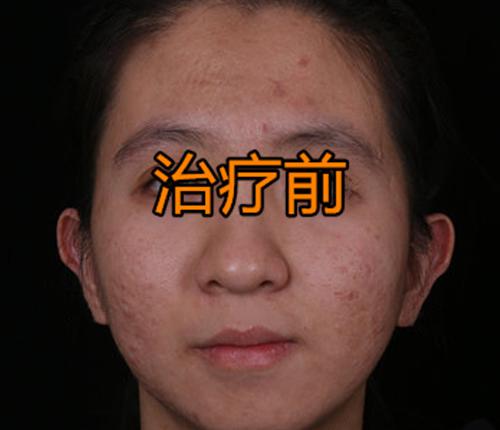 痘坑修复激光手术大概要多少钱（张女士激光治疗后）