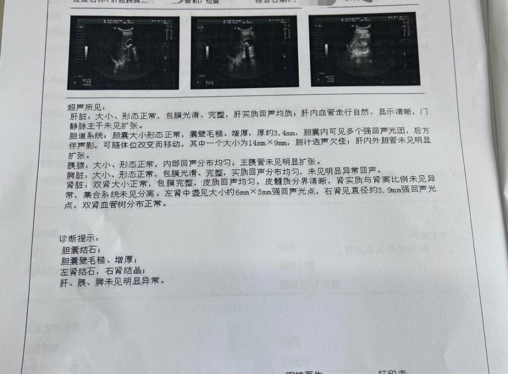 结石手术大概多少钱（6mm肾结石）