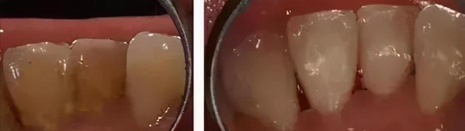 洗牙齿大概多少钱（洗牙疼不疼）