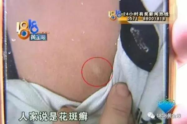 白殿疯确诊要多少钱（两个白点）