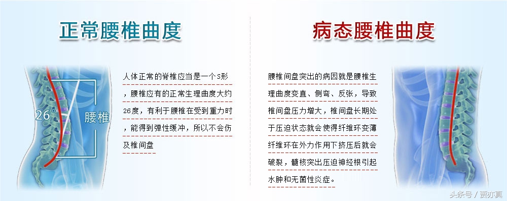 曲度牌腰椎治疗仪多少钱一台（腰椎间盘突出不要忽视腰疼）