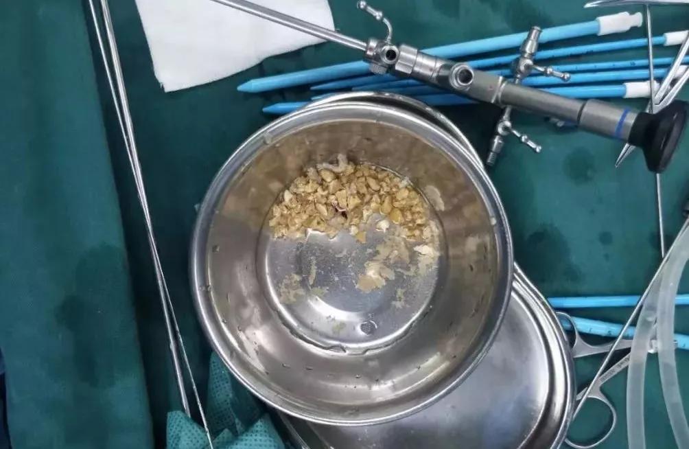 结石手术大概多少钱（打孔取石）
