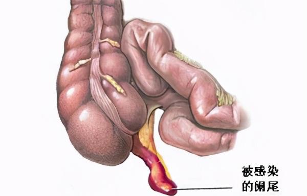 闌尾炎微創(chuàng)手術(shù)多少錢（闌尾炎手術(shù)治療）