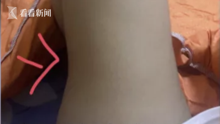 抽脂手術大概要多少錢（借2萬）