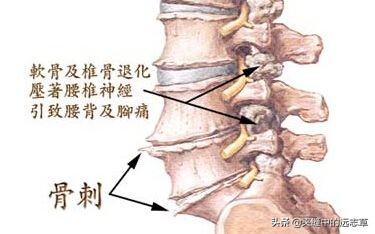 白驳风治疗需多少钱（骨质增生）