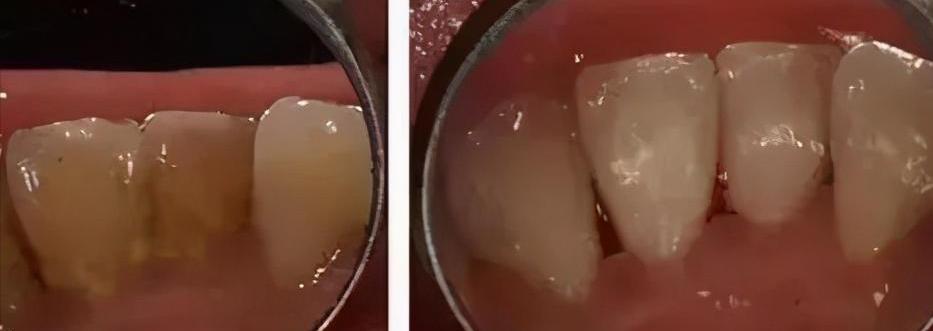 洗牙多少钱（洗牙疼不疼）