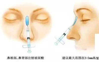 自体隆鼻大概需多少钱（详述）