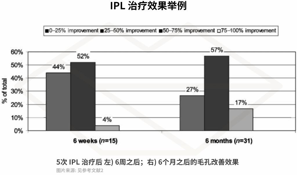 激光收缩毛孔多少钱一次（毛孔粗大十几年）