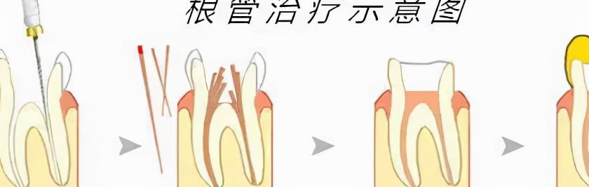 根管治疗一颗牙多少钱（被根管治疗吓哭了）