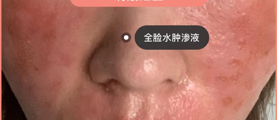 医院刷酸一次多少钱（闭口痘痘肌看过来）