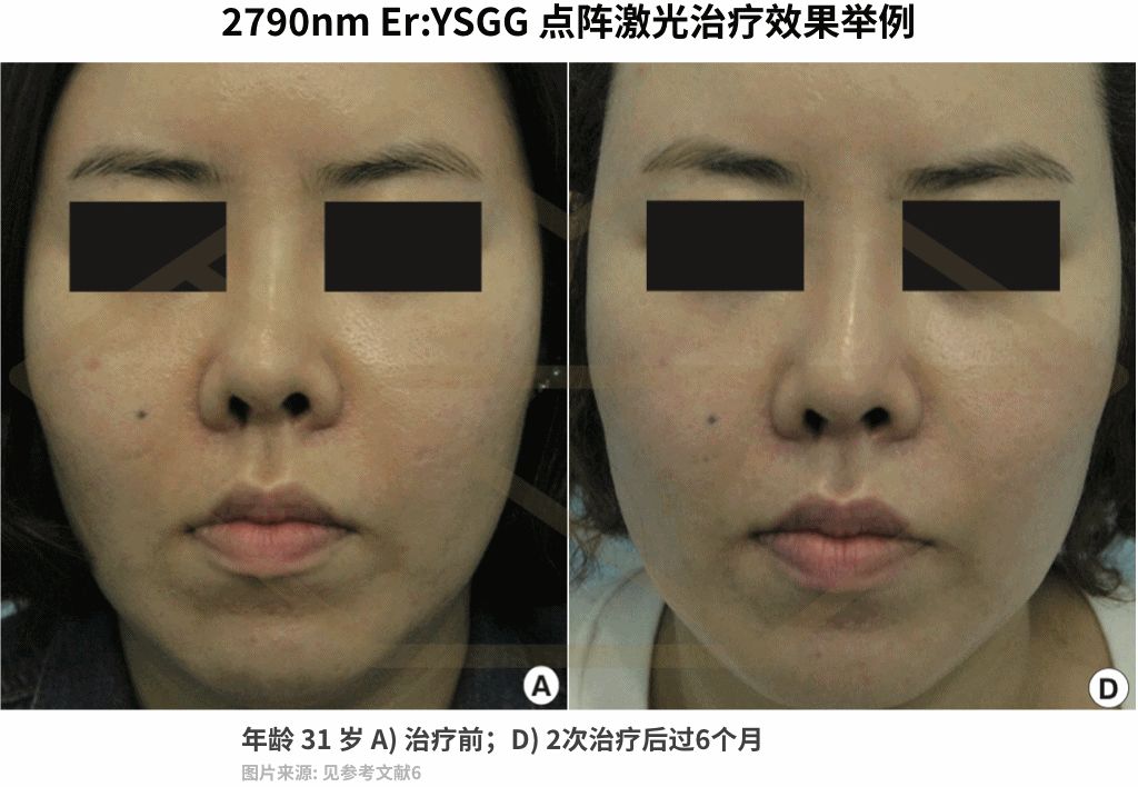 激光收缩毛孔多少钱一次（毛孔粗大十几年）