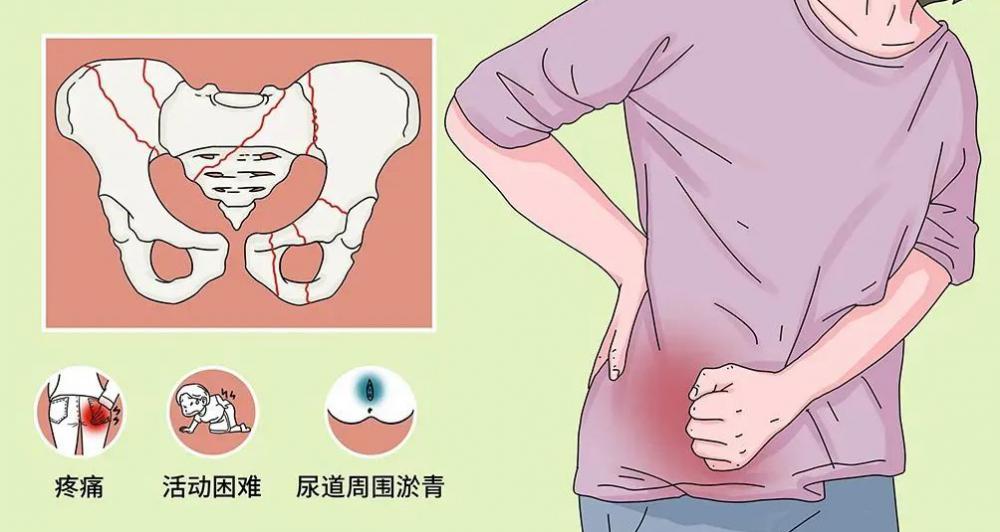 骨盆修复大概需要多少钱（骨盆伤得）