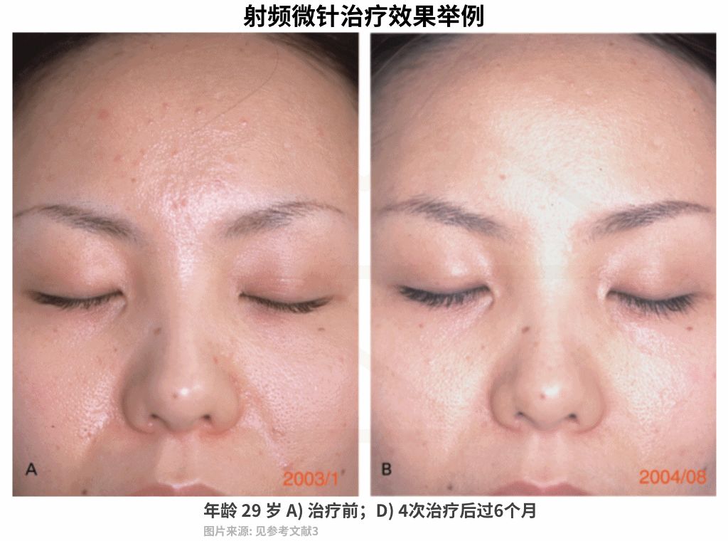 激光收缩毛孔多少钱一次（毛孔粗大十几年）