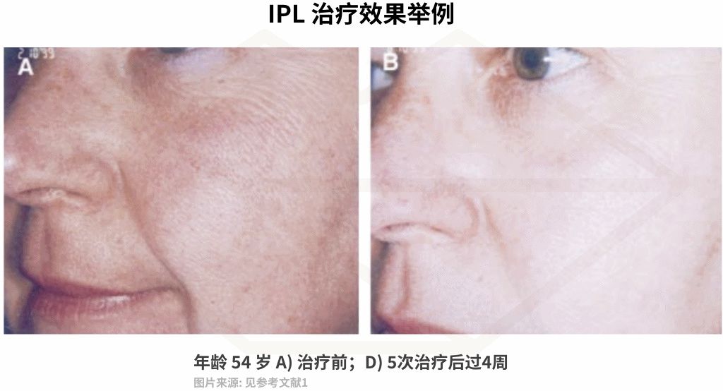 激光收缩毛孔多少钱一次（毛孔粗大十几年）