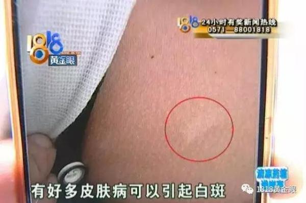 白殿疯确诊要多少钱（两个白点）
