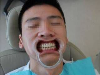 激光美白全身多少钱一次（即日起）