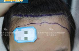 移植头发多少钱（毛囊移植后的头发是永久的吗）