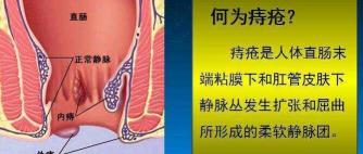 割个痔疮手术多少钱（什么痔疮需要手术）