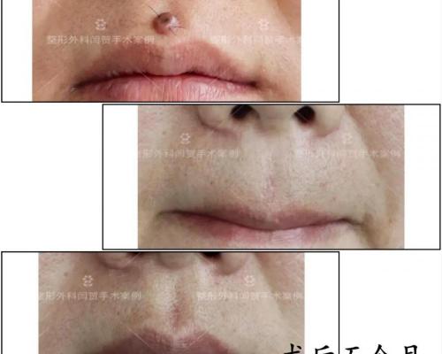 切痣手术多少钱（去痣是选择激光点掉还是手术切除呢）