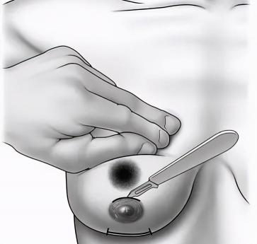 全乳房切除需要多少钱（医生建议乳房全切）