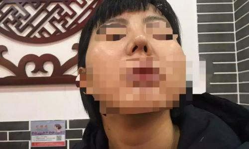 鼻子修复多少钱（女子花1万7隆鼻）