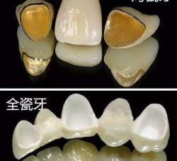 全瓷牙冠多少钱一颗（全瓷牙到底比烤瓷牙好在哪）