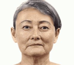 除皱激光多少钱（常见用于除皱的医美项目优缺点）