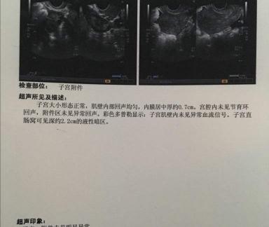 抽积液一次费用多少钱（女性之痛）