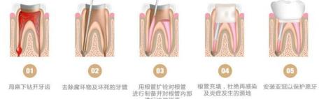 做根管治疗多少钱（为啥根管治疗这么贵）