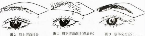 激光洗眉一般需要多少钱（切眉）