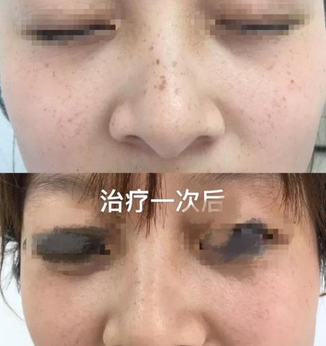 做激光祛斑一般多少钱（激光祛斑就选柴桑区人民医院）