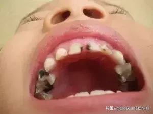 窝沟封闭多少钱（宝宝都该做的窝沟封闭）