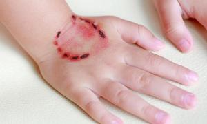 人被咬了打狂犬疫苗多少钱（被猫）