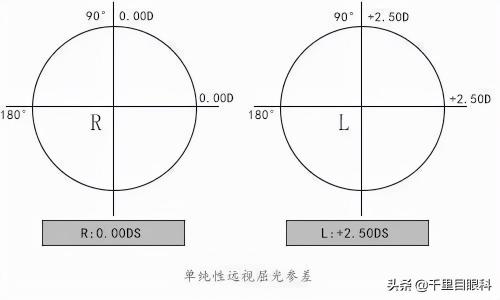 大小眼矫正手术多少钱（双眼近视度数差异大）