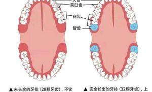 智齿拔一颗多少钱（智齿拔不拔）