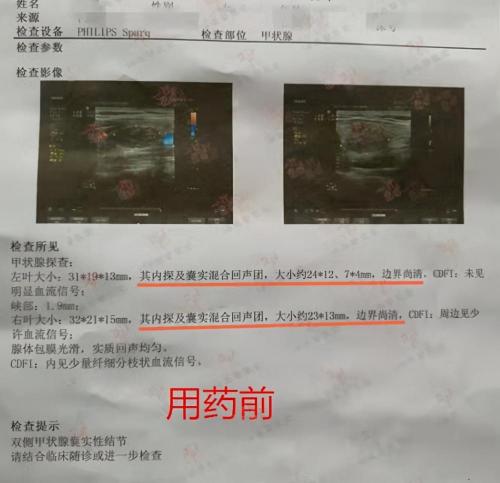做甲状腺结节手术需要多少钱（一则真实的案例说明）