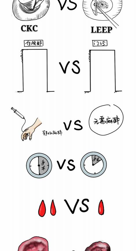 宫颈锥切术要多少钱（图解冷刀锥切和LEEP的不同）